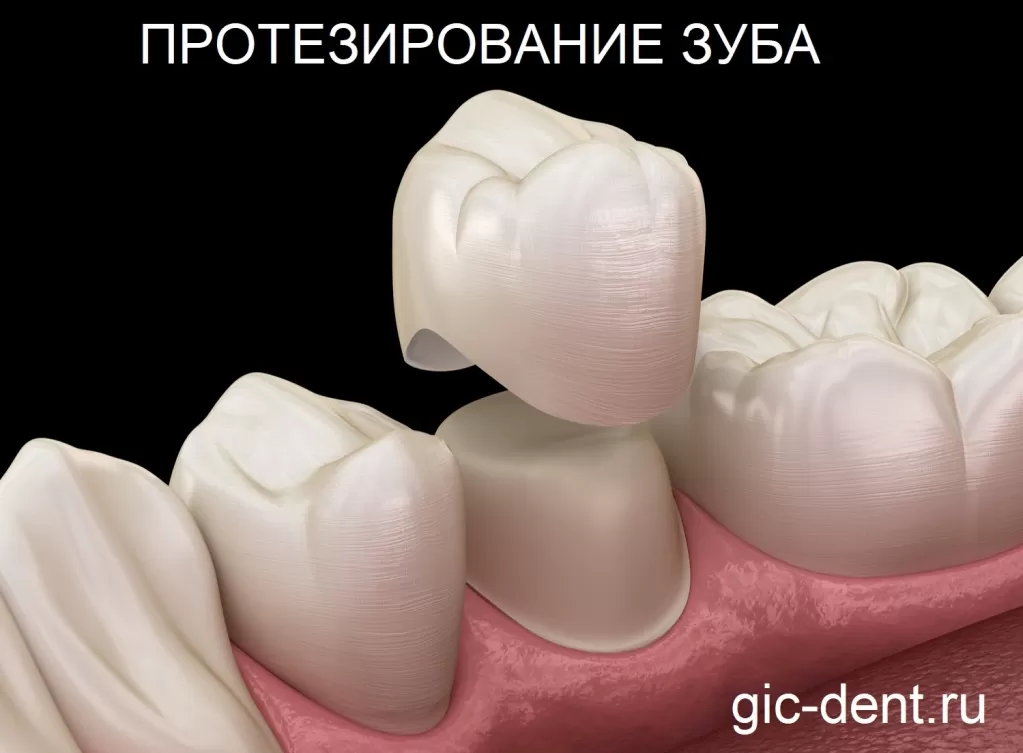 Протезирование собственных зубов не требует установки имплантата